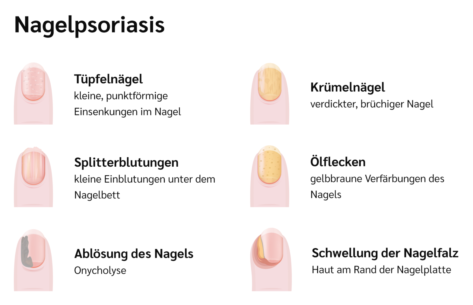 Psoriasis an den Nägeln - Sorea Health